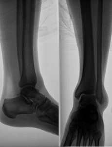 1002813_x-ray_image_of_the_leg